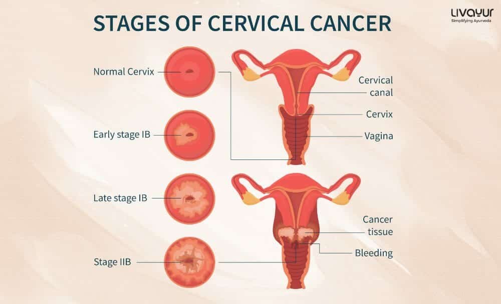 Cervical Cancer Cervical Cancer