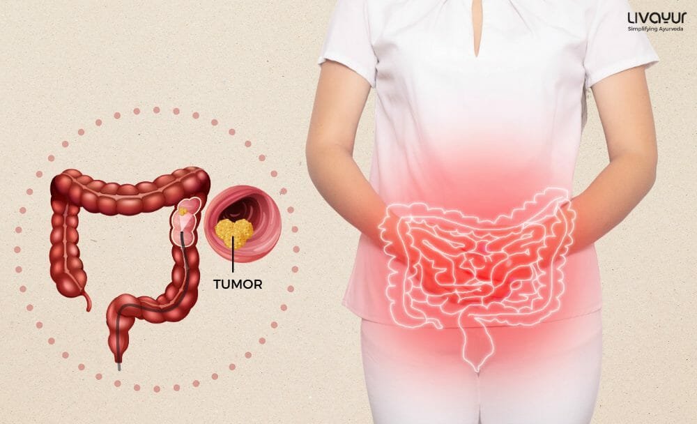 Colorectal Cancer