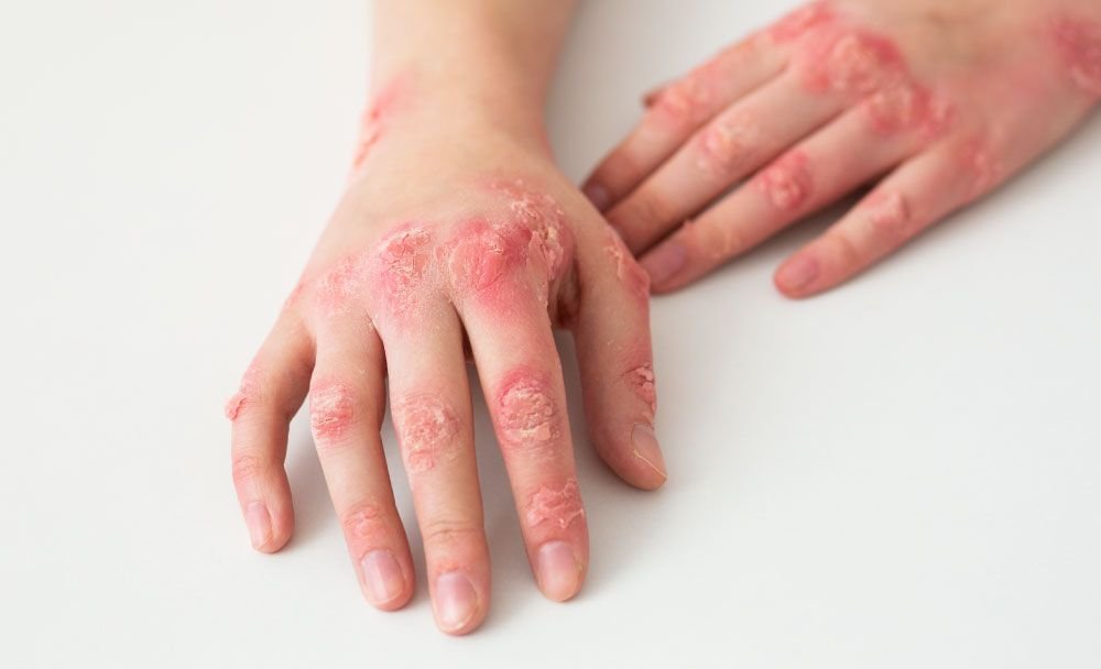 Hand with Syphilis Symptoms syphilis symptoms