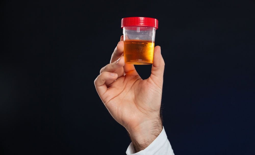 symptoms of jaundice - dark urine