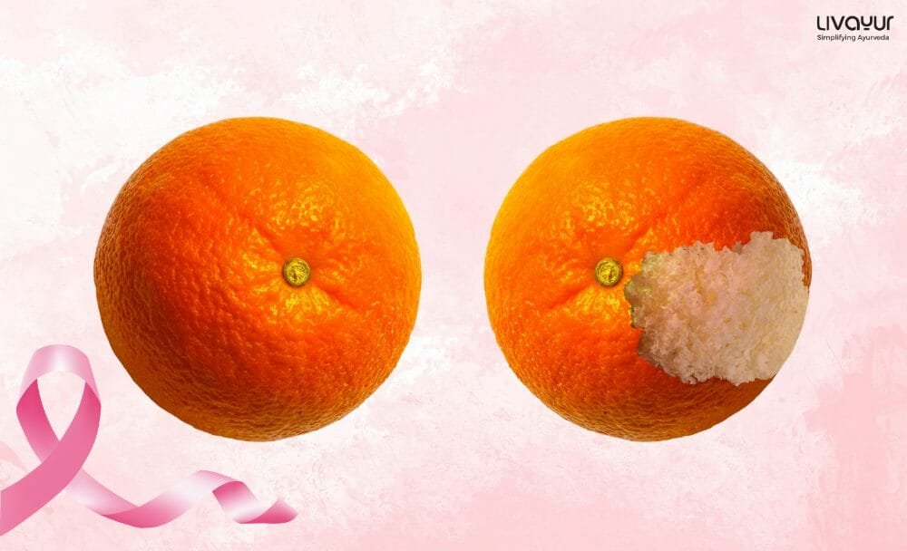(in-article image)Breast Cancer in article imageBreast Cancer