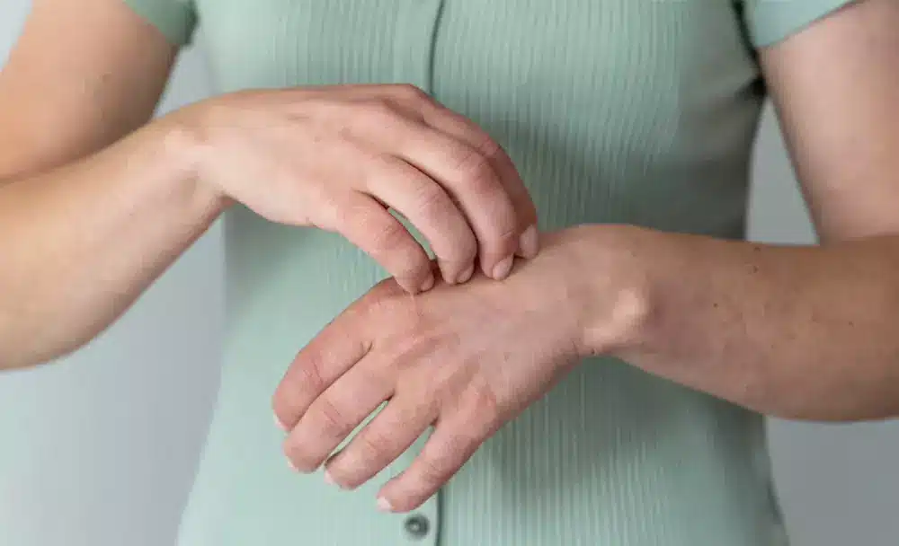 scabies symptoms & causes