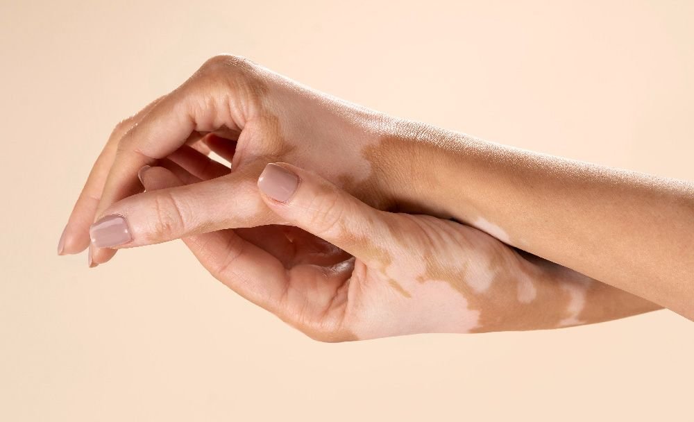 what is leucoderma