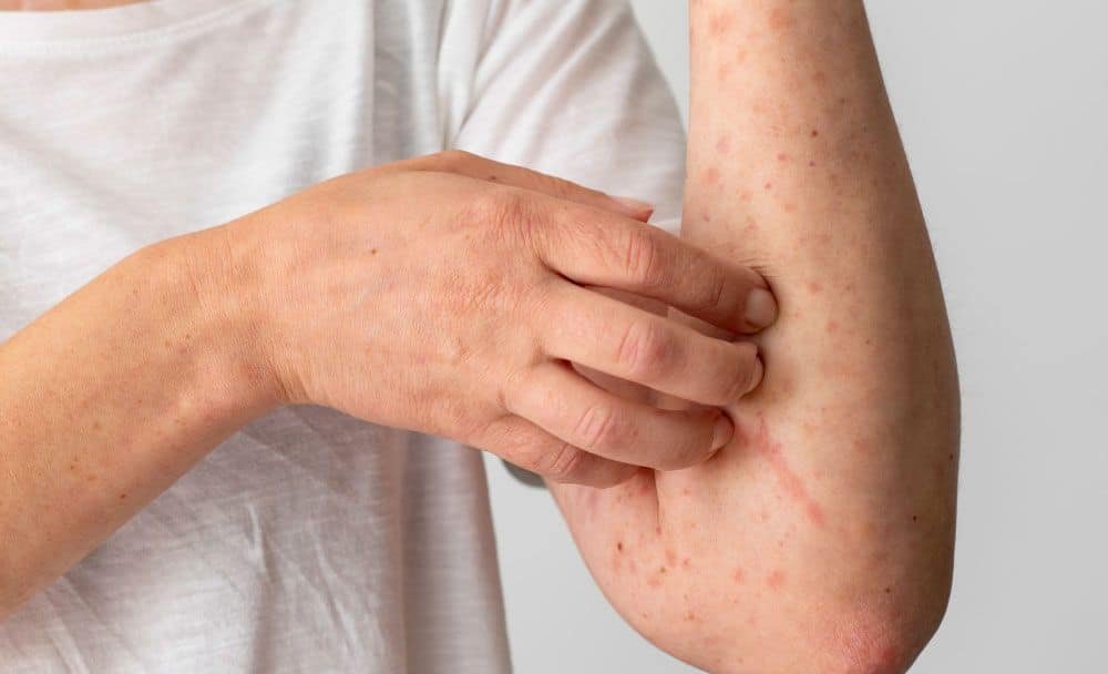 skin rash - livayur