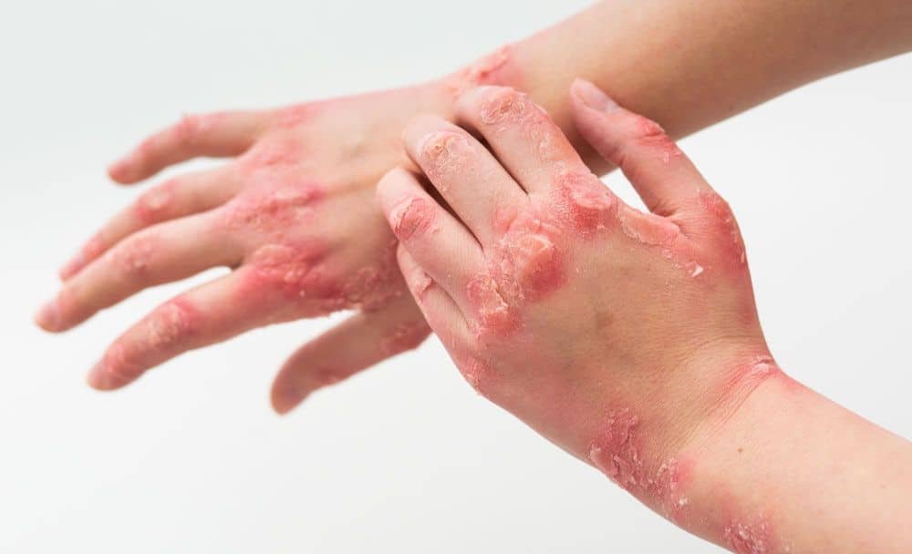 measles causes