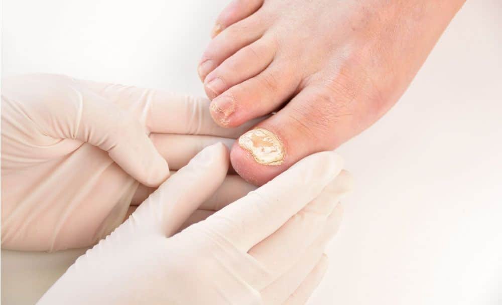types of fungal infections