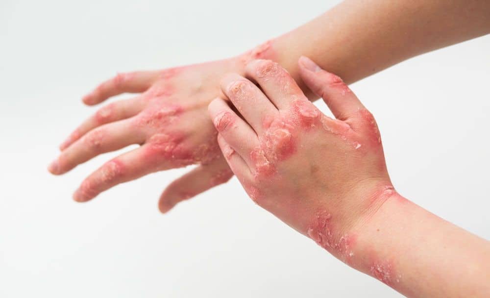 leech therapy benefits - skin diseases
