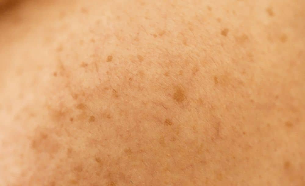 melasma - livayur