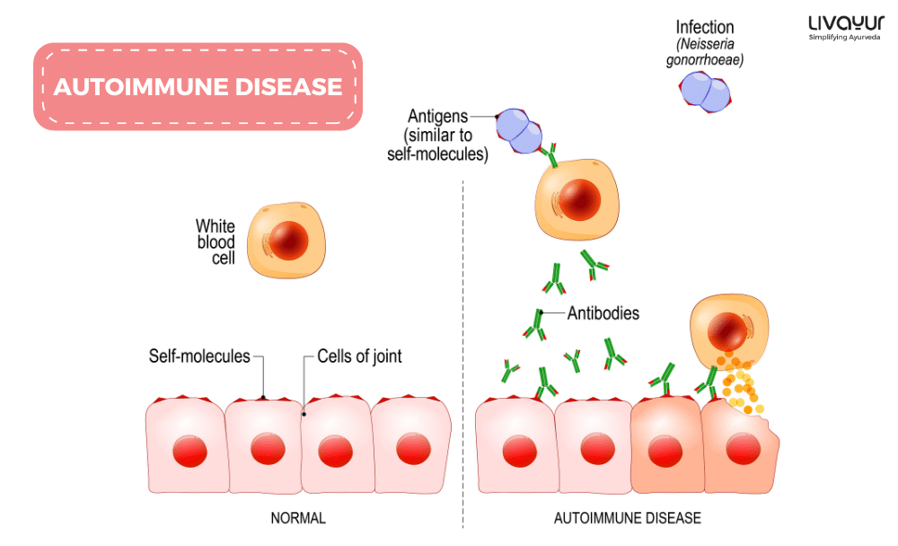 Autoimmune Disease Causes, Symptoms, Types, Treatment & More Autoimmune Disease Causes Symptoms Types Treatment More