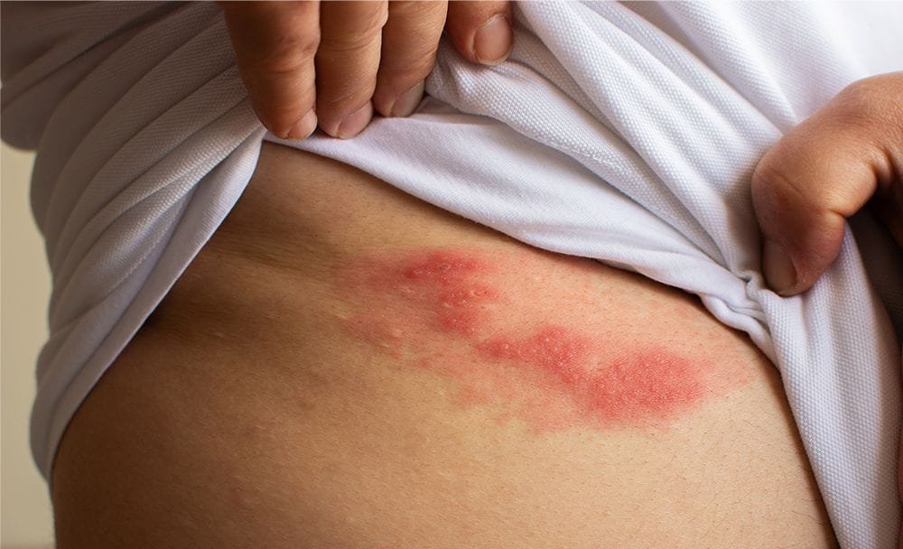 shingles - livayur