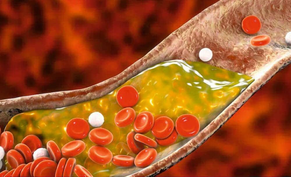 ayurveda for cholesterol