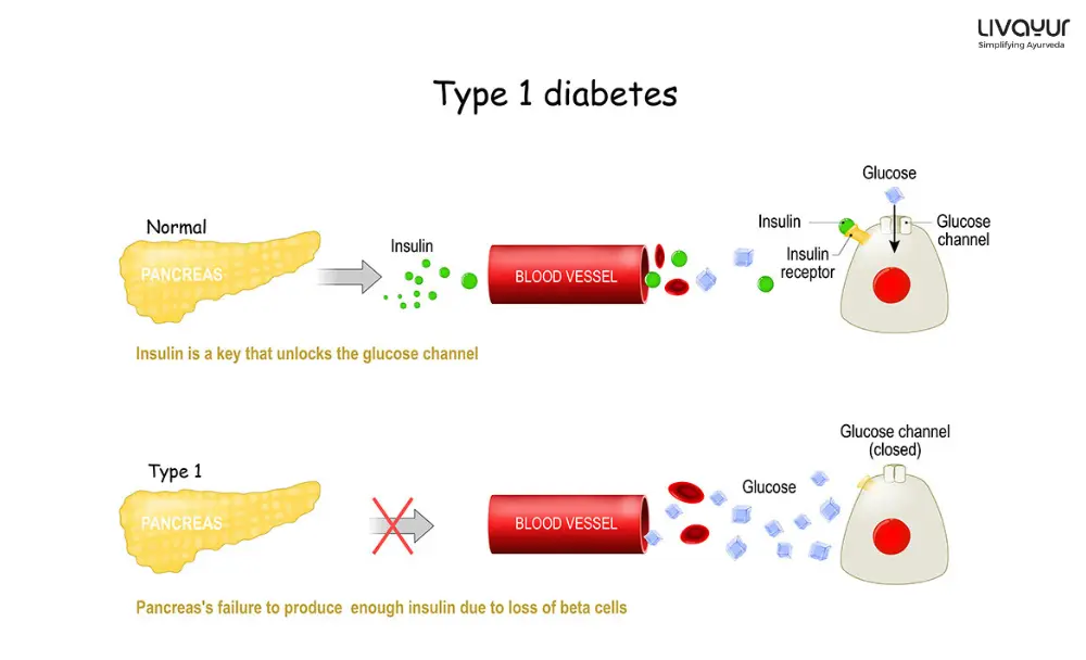 Type 1 diabetes